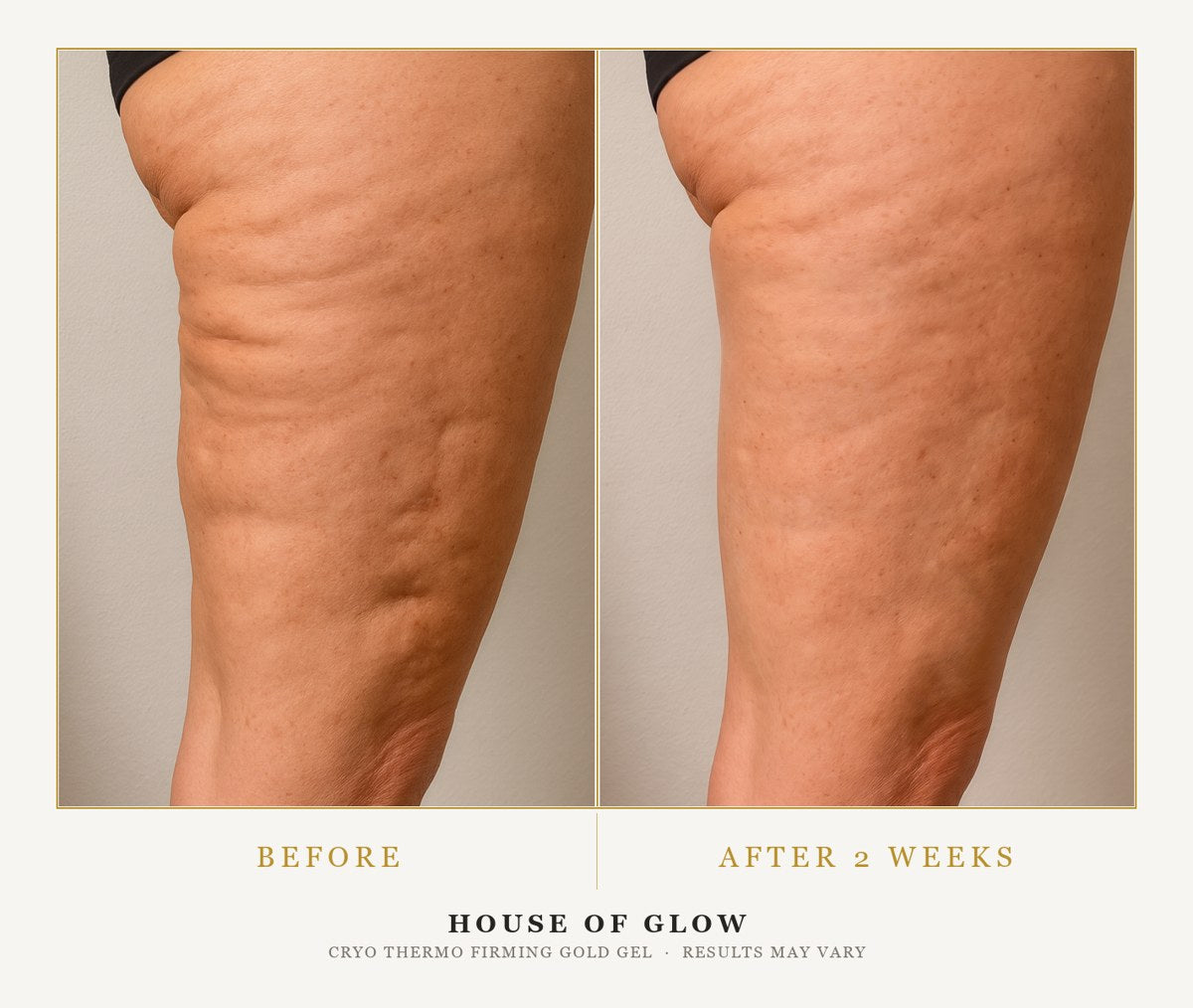 Thigh before, and after two weeks of the Cryo Thermo Gold Gel
