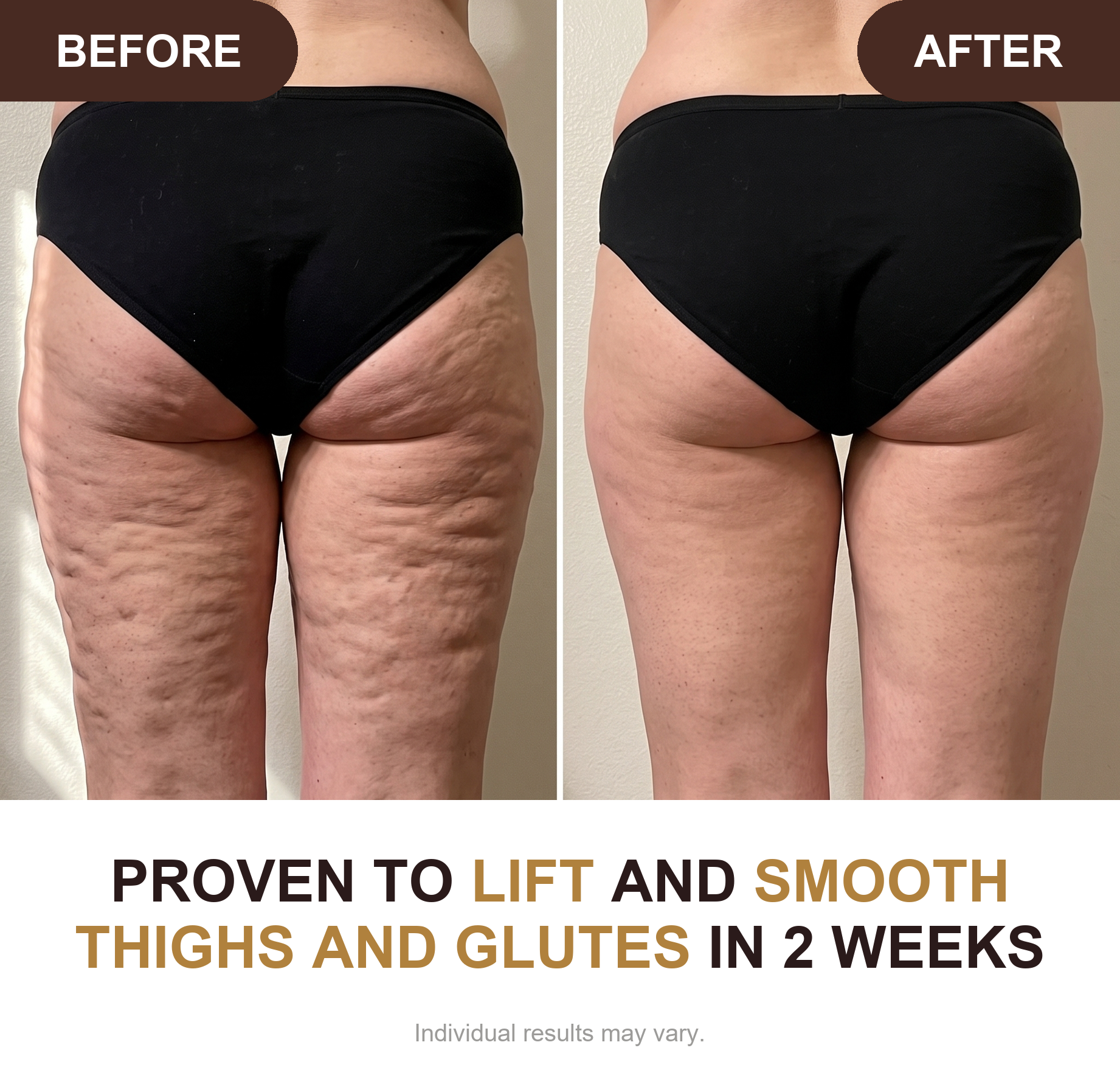 Before and after cellulite results on thighs and buttocks