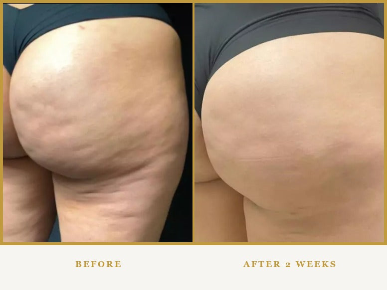 Before and after, Butt, two weeks