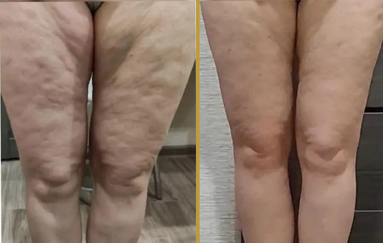 Before and after view of thighs and knees