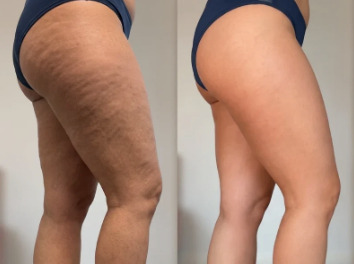 Before and after cellulite results on the thigh and glute