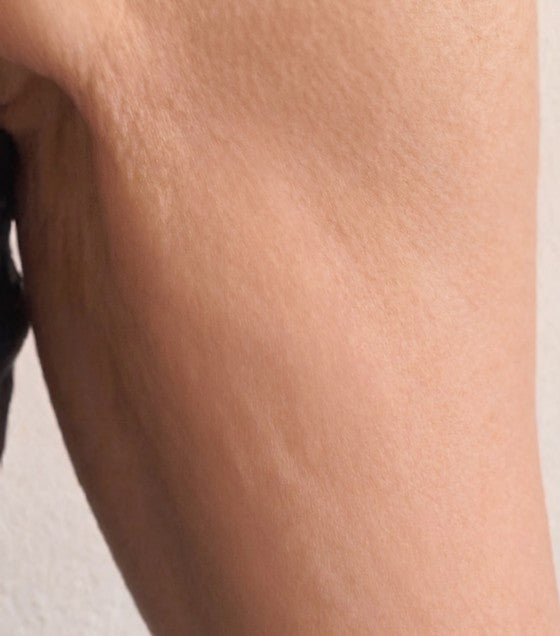 Upper arm after: smoother, tighter-looking skin