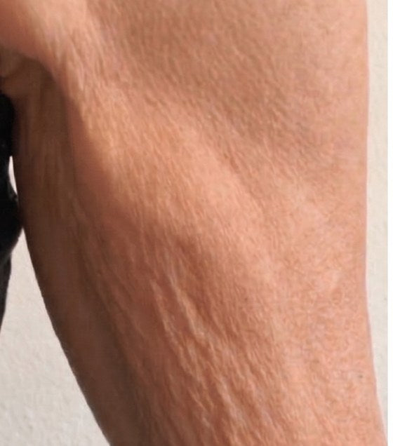 Upper arm before: crepey texture