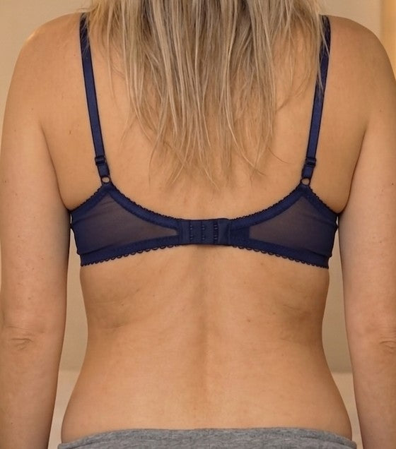 Back after: smoother, firmer-looking skin