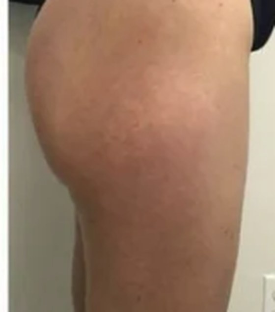 Thigh and glute after: smooth and firm