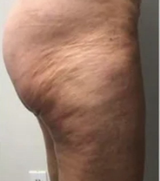Thigh and glute before: visible dimpling
