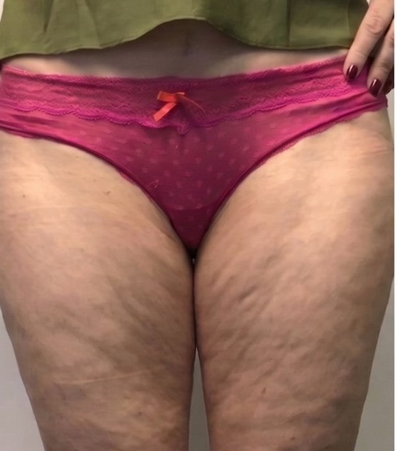 Thigh before: dimpled texture
