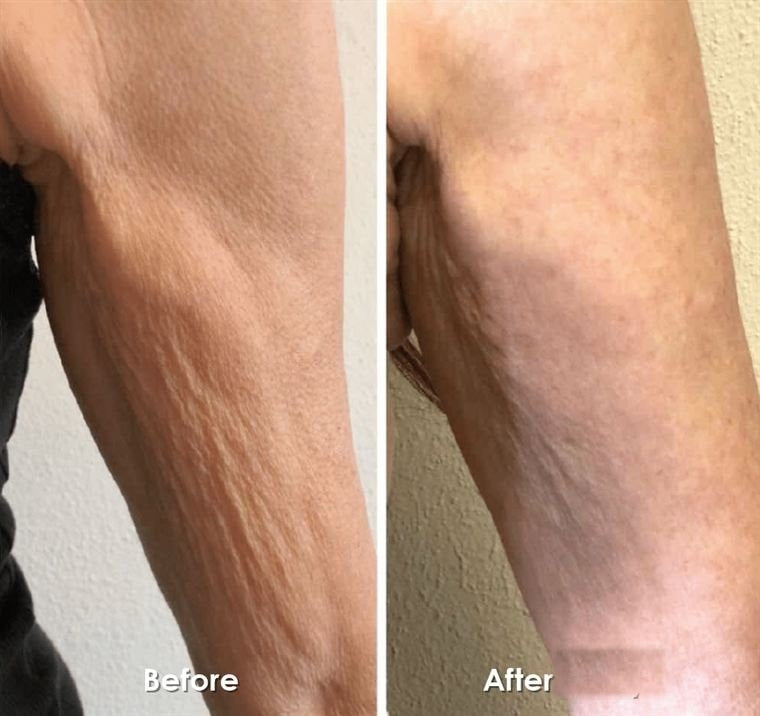 The friend's arms, before and after