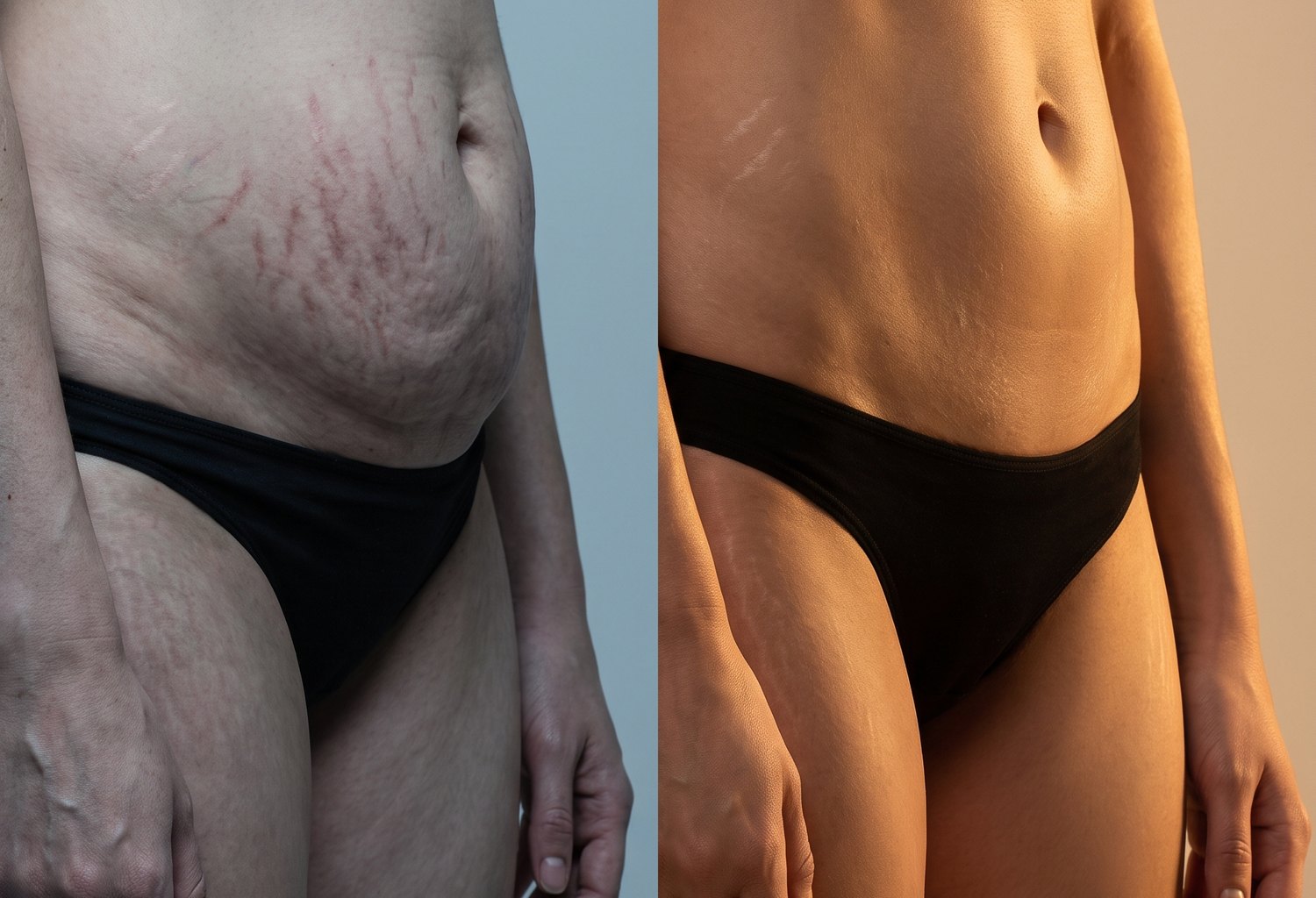 A postpartum belly before and after daily use, stretch marks faded and skin firmer